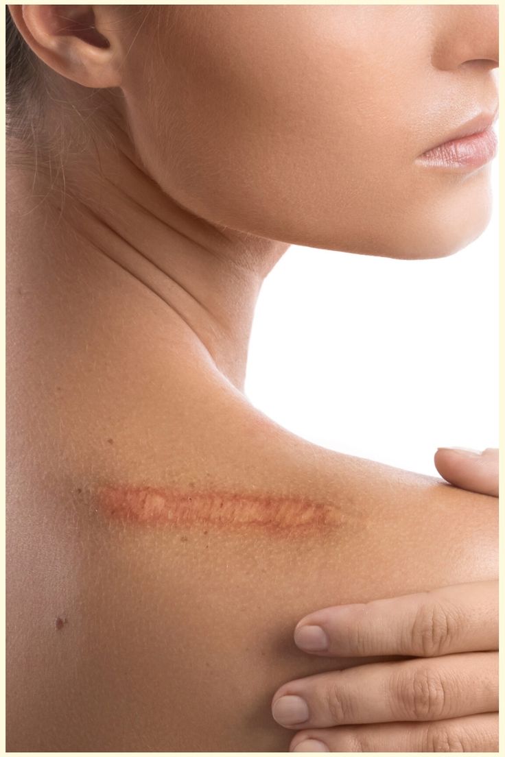 Scar Revision